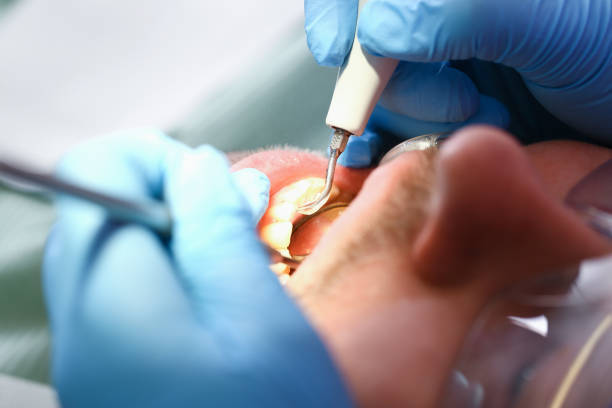 Best Emergency Root Canal Treatment in Potterville, MI
