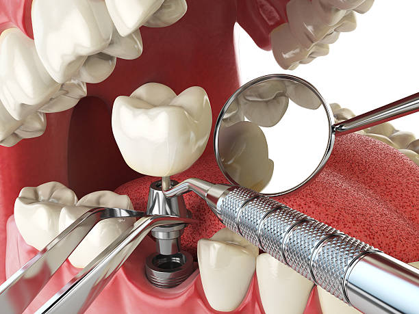 Best Emergency Dentist for Lost Fillings or Crowns in Potterville, MI